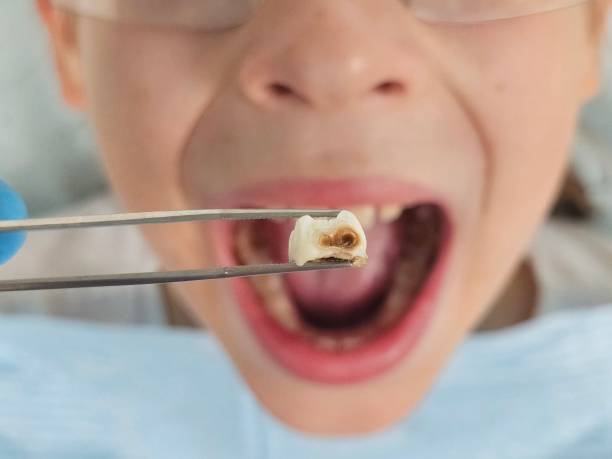 Best Emergency Dental Extractions in Crestview, FL